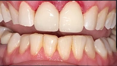 Before and after photos of a chipped front tooth fixed with veneers — after