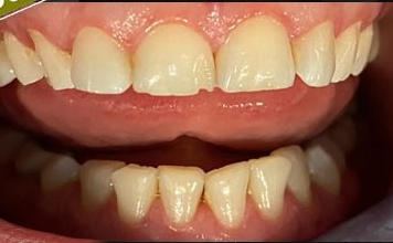 Before and after photos of a chipped front tooth fixed with veneers — before